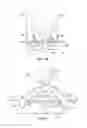 Fig. 12 - Method and apparatus for restoring improper morphology of the alveolar bone