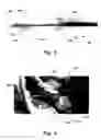 Fig. 03 - System and a method for delivery of an annuloplasty implant
