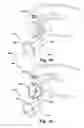 Fig. 04 - System and a method for delivery of an annuloplasty implant