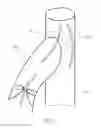 Fig. 04 - Prosthetic valve for treating diseases causing reflux affecting the lower limbs