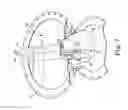 Fig. 07 - Penile prosthetic with an insertion tool contained inside an inflatable bladder