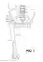 Fig. 02 - PROSTHETIC PLACEMENT TOOL AND ASSOCIATED METHODS