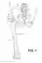 Fig. 02 - PROSTHETIC PLACEMENT TOOL AND ASSOCIATED METHODS