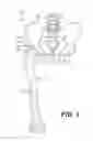 Fig. 02 - PROSTHETIC PLACEMENT TOOL AND ASSOCIATED METHODS