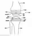 Fig. 01 - Adjustable tibial trial