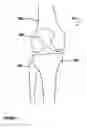 Fig. 02 - Adjustable tibial trial