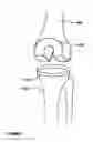 Fig. 06 - Adjustable tibial trial