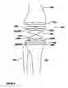 Fig. 07 - Adjustable tibial trial