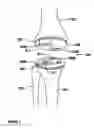 Fig. 08 - Adjustable tibial trial