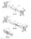 Fig. 02 - Variable Size Intragastric Implant Devices