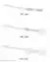 Fig. 33 - Device for intermittently obstructing a gastric opening