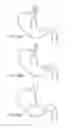 Fig. 35 - Device for intermittently obstructing a gastric opening
