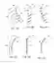 Fig. 14 - PARTIALLY ERODABLE SYSTEMS FOR TREATMENT OF OBSTRUCTIVE SLEEP APNEA