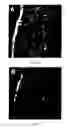 Fig. 08 - Method of stem cell delivery into the brain during chronic disease using blood brain barrier permeabilizers