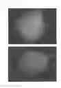 Fig. 18 - Method for treating alopecia with B-type natriuretic peptide