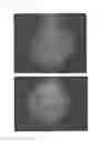 Fig. 19 - Method for treating alopecia with B-type natriuretic peptide