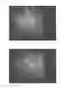Fig. 32 - Method for treating alopecia with B-type natriuretic peptide