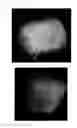 Fig. 41 - Method for treating alopecia with B-type natriuretic peptide