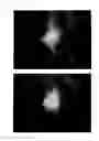 Fig. 42 - Method for treating alopecia with B-type natriuretic peptide