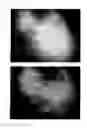 Fig. 44 - Method for treating alopecia with B-type natriuretic peptide