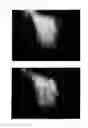 Fig. 45 - Method for treating alopecia with B-type natriuretic peptide
