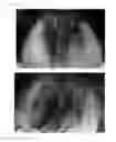 Fig. 46 - Method for treating alopecia with B-type natriuretic peptide
