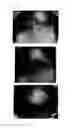 Fig. 47 - Method for treating alopecia with B-type natriuretic peptide