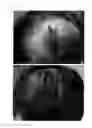 Fig. 48 - Method for treating alopecia with B-type natriuretic peptide