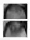 Fig. 49 - Method for treating alopecia with B-type natriuretic peptide