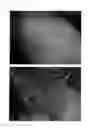 Fig. 50 - Method for treating alopecia with B-type natriuretic peptide