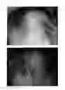 Fig. 51 - Method for treating alopecia with B-type natriuretic peptide