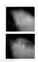 Fig. 52 - Method for treating alopecia with B-type natriuretic peptide