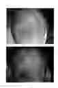 Fig. 57 - Method for treating alopecia with B-type natriuretic peptide