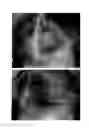 Fig. 62 - Method for treating alopecia with B-type natriuretic peptide