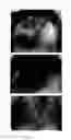Fig. 64 - Method for treating alopecia with B-type natriuretic peptide