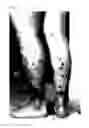 Fig. 03 - Use of CGRP antagonist compounds for treatment of psoriasis