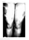 Fig. 04 - Use of CGRP antagonist compounds for treatment of psoriasis