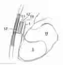 Fig. 01 - Heart help device, system, and method