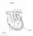 Fig. 19 - Heart help device, system, and method