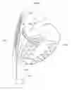 Fig. 26 - Heart help device, system, and method