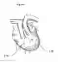 Fig. 19 - Heart help device, system and method