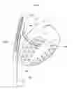 Fig. 26 - Heart help device, system and method
