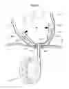 Fig. 47 - Heart help device, system and method