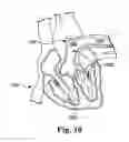 Fig. 15 - Catheter and catheter system for electrical neuromodulation