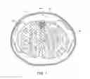 Fig. 02 - ELECTRODE ARRAY CONFIGURED TO WRAP AROUND AND STIMULATE THE SPINAL CORD