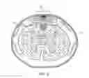 Fig. 04 - ELECTRODE ARRAY CONFIGURED TO WRAP AROUND AND STIMULATE THE SPINAL CORD