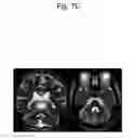 Fig. 11 - DETECTION METHOD FOR GENETIC DISEASE