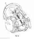 Fig. 17 - Birthing simulation devices, systems, and methods