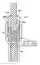 Fig. 01 - CORROSION AND WEATHER RESISTANT ASSEMBLY FOR A STUFFING TUBE AND A METHOD FOR MAKING A GASKET FOR USE THEREWITH