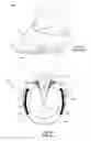 Fig. 02 - Horseshoe assembly and a method of mounting the same onto a horse hoof